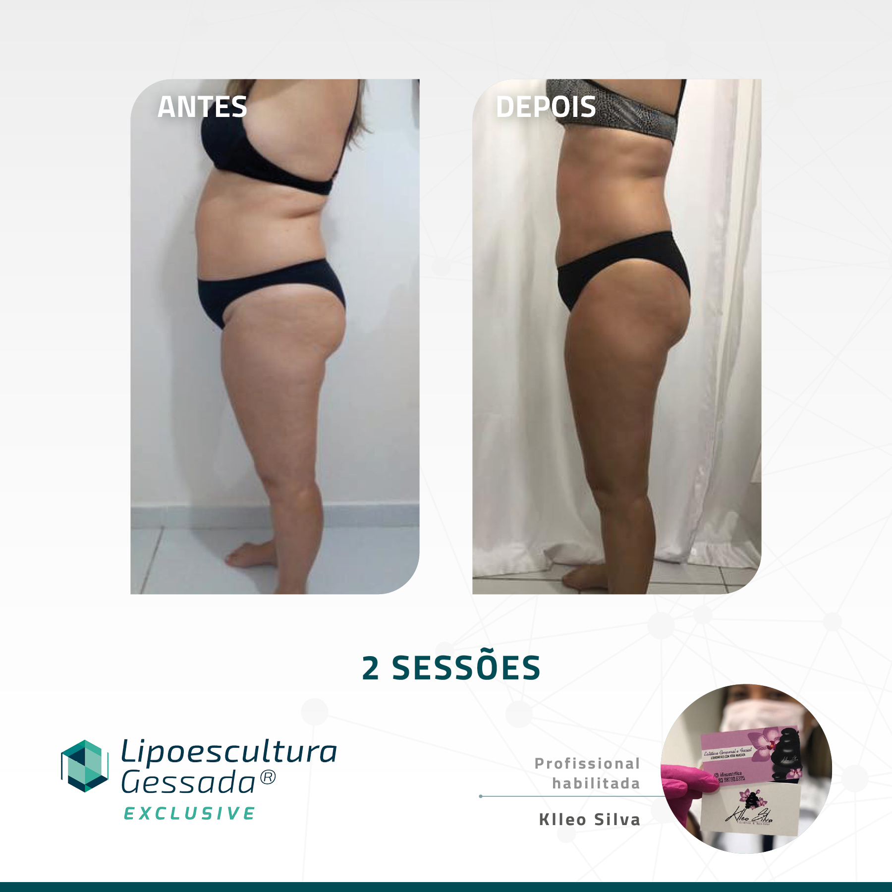 Antes e depois com a Lipoescultura Gessada