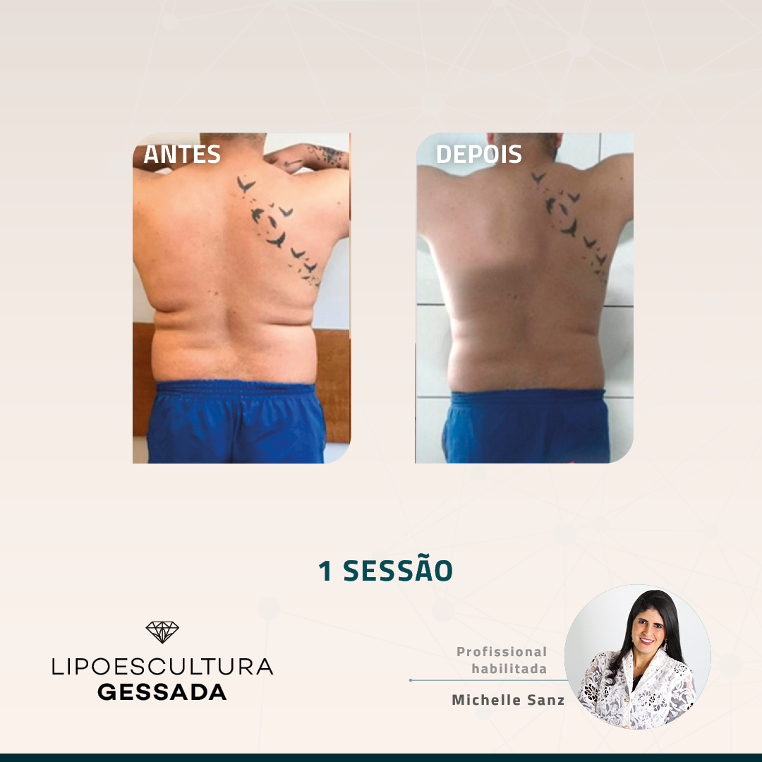 Antes e depois com a Lipoescultura Gessada