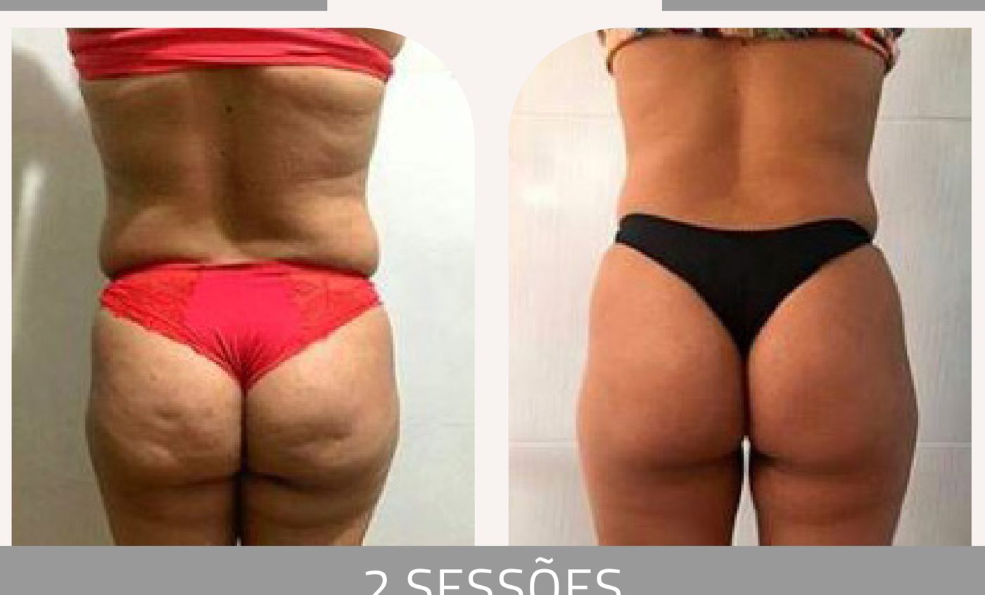Antes e depois com a Lipoescultura Gessada — Apresentação Oficial Bothanica Mineral