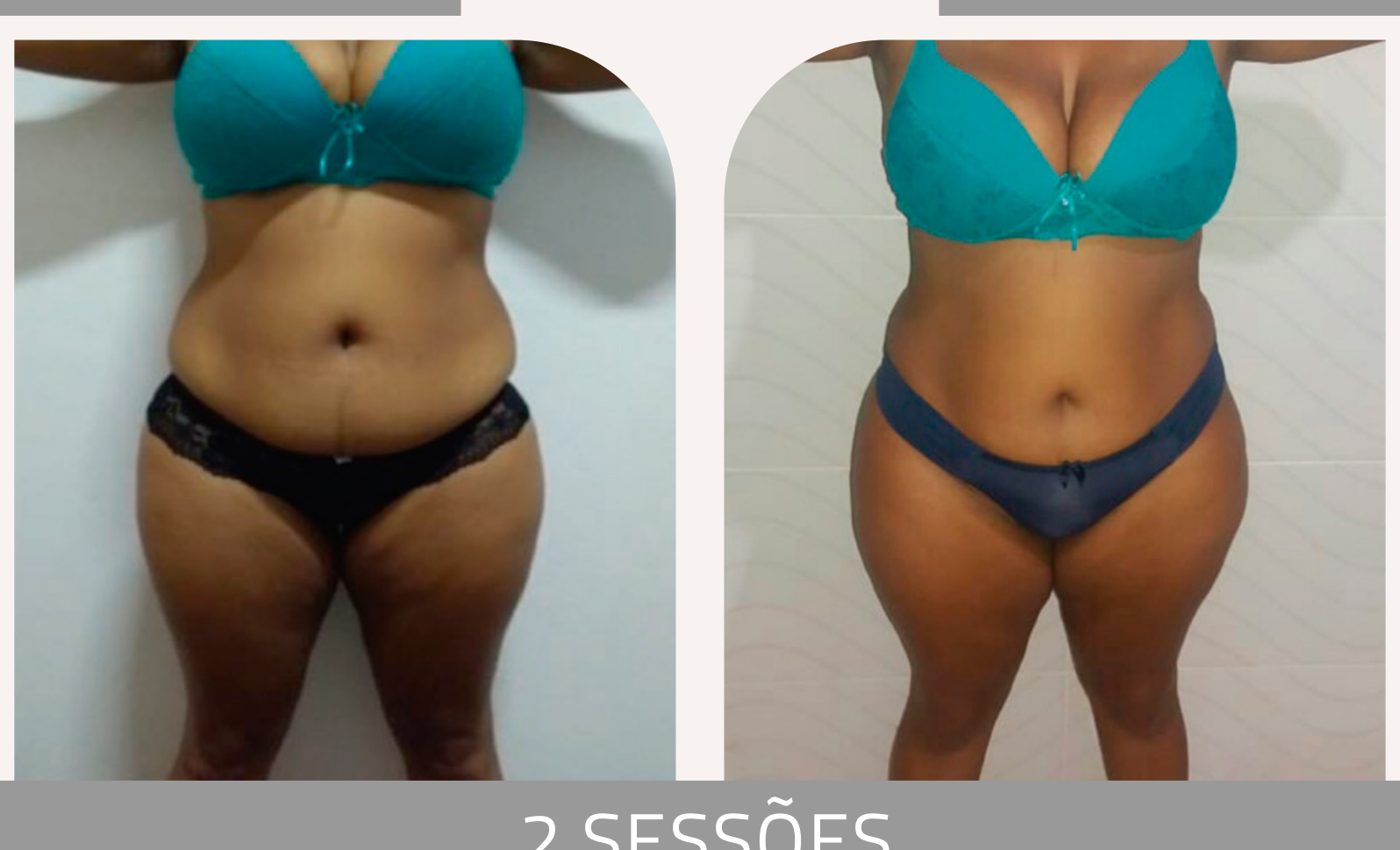 Antes e depois com a Lipoescultura Gessada — Apresentação Oficial Bothanica Mineral