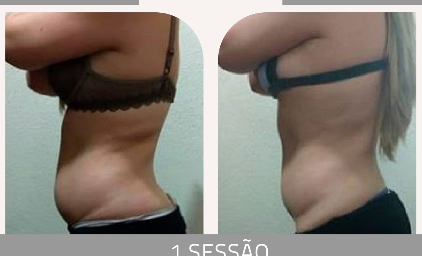 Antes e depois com a Lipoescultura Gessada — Apresentação Oficial Bothanica Mineral
