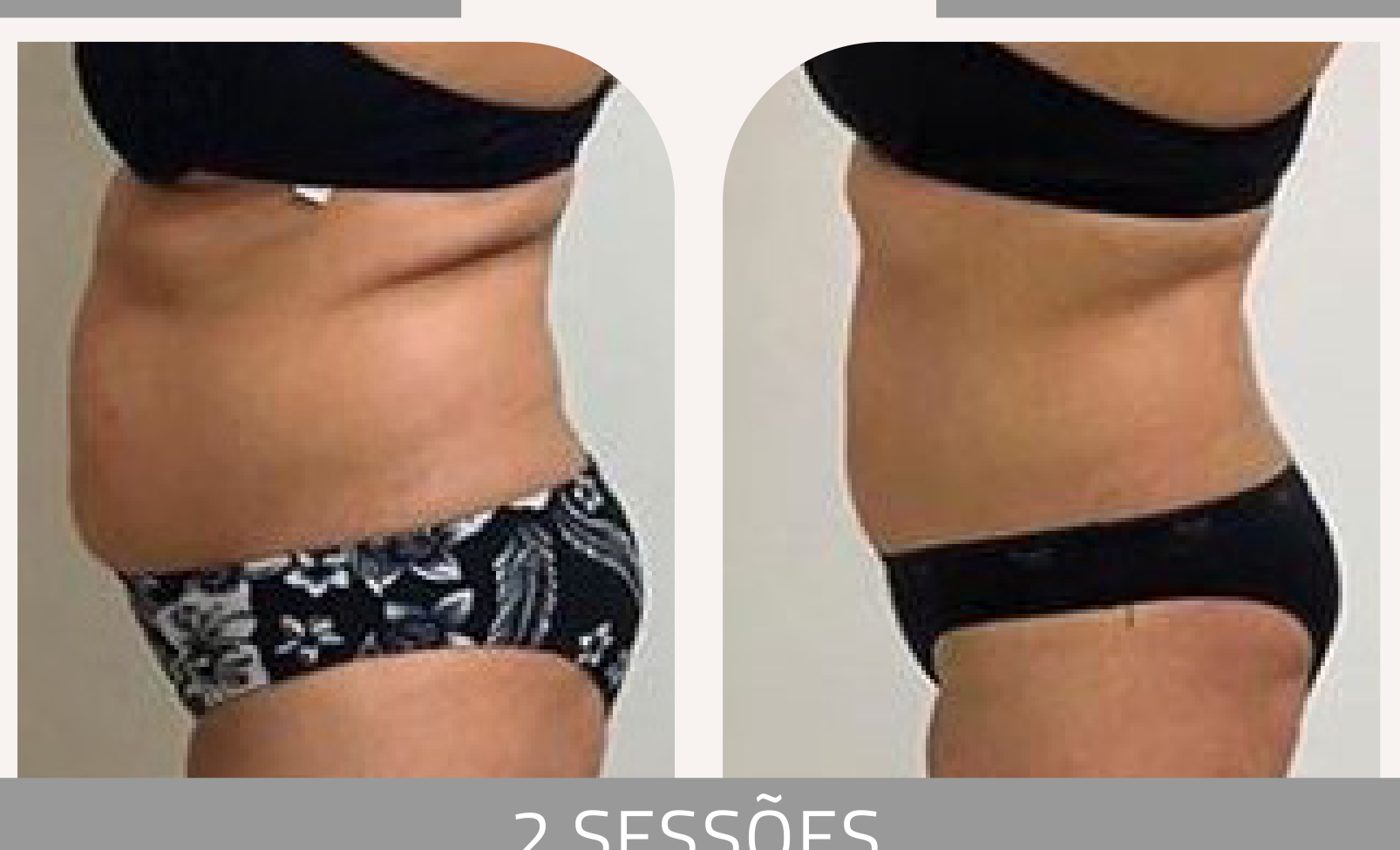 Antes e depois com a Lipoescultura Gessada — Apresentação Oficial Bothanica Mineral