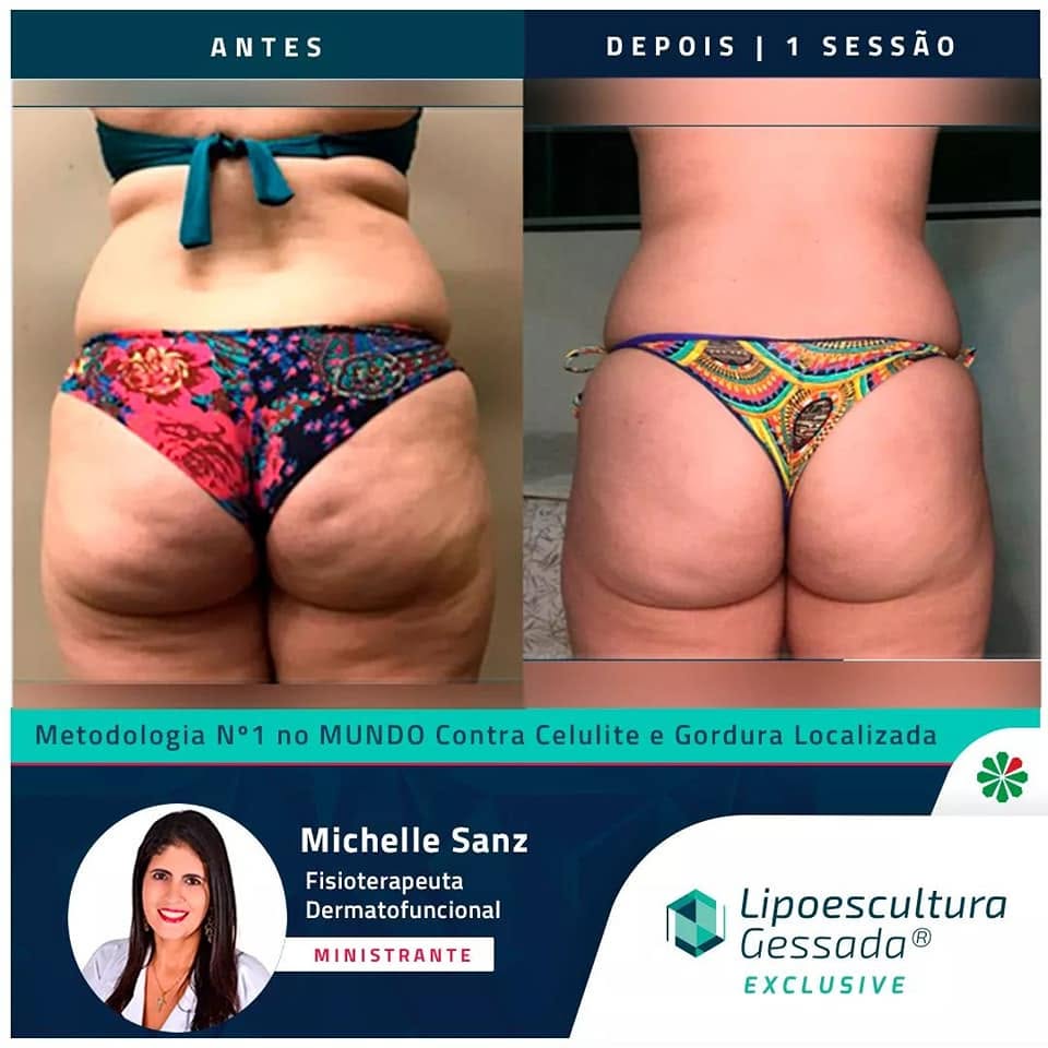 Antes e depois com a Lipoescultura Gessada — glúteos, resultado de 1 sessão