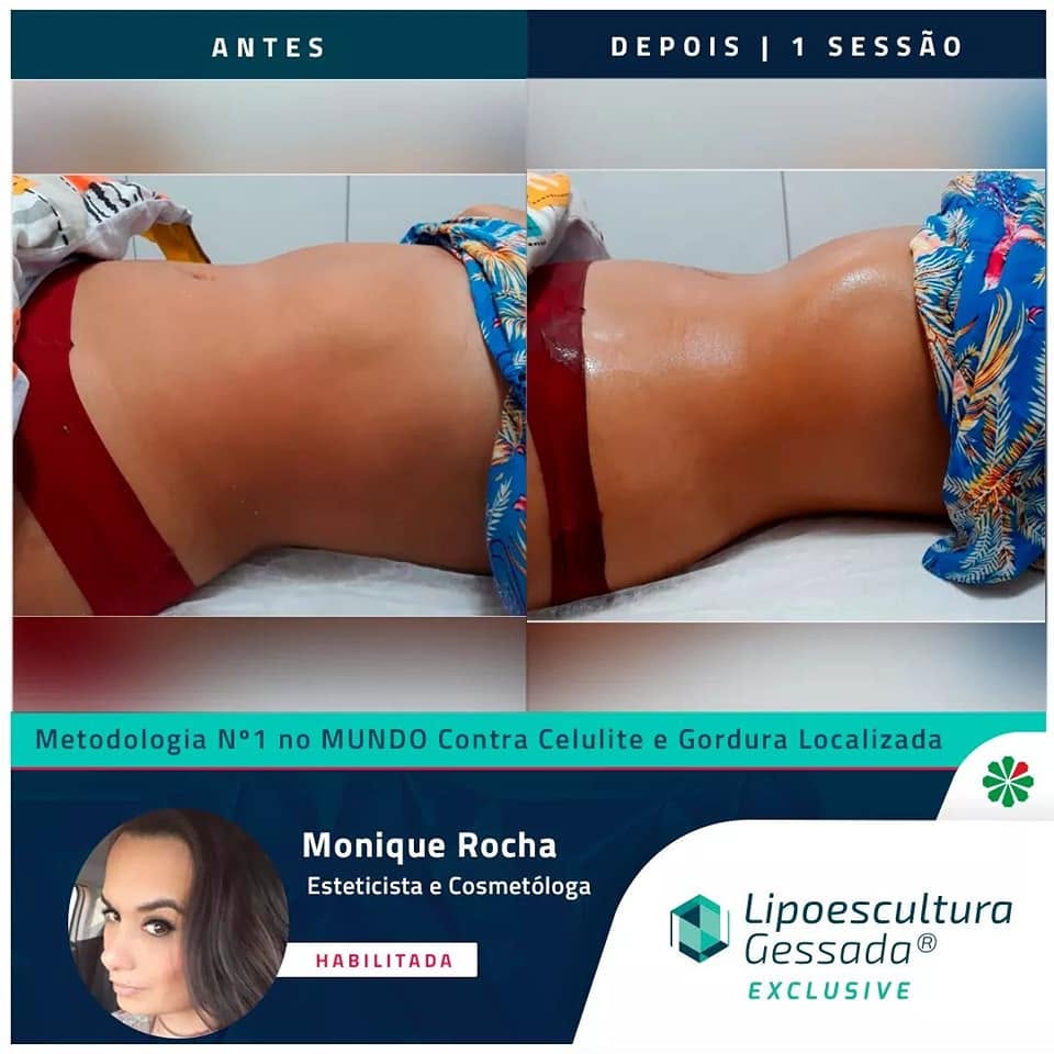 Antes e depois com a Lipoescultura Gessada — resultado imediato em 1 sessão