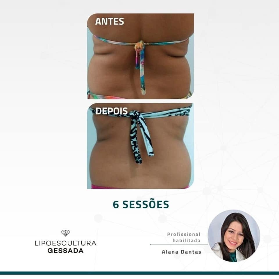 Antes e depois com a Lipoescultura Gessada — resultado de 6 sessões